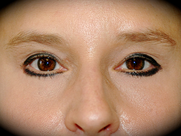 Brow Lift before and after - after