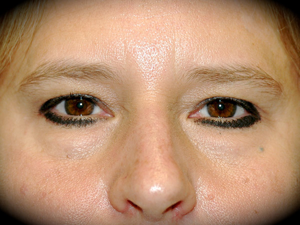 Brow Lift before and after - before