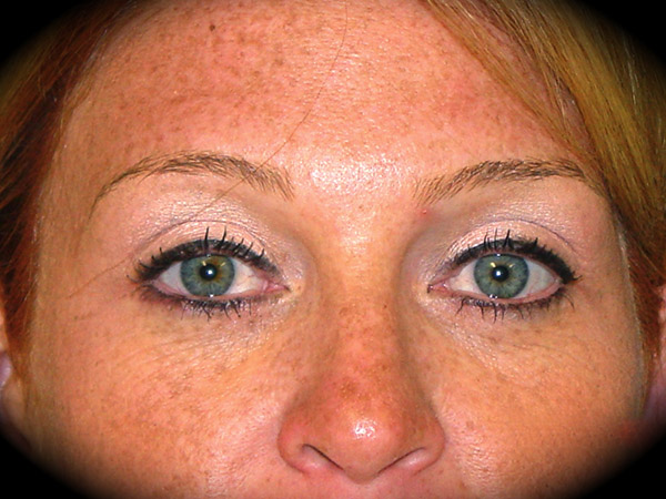 Brow Lift before and after - after