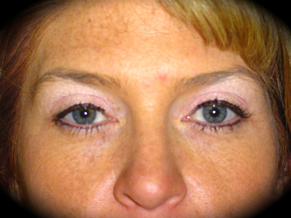 Brow Lift before and after - before