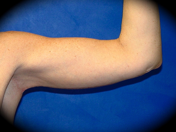 Arm Lift before and after - after