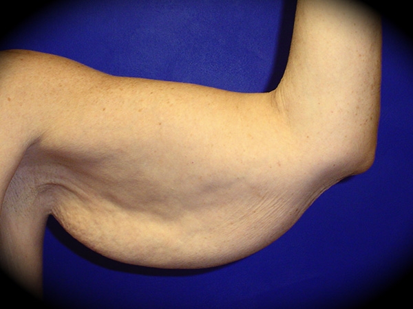 Arm Lift before and after - before