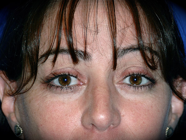 Brow Lift before and after - after