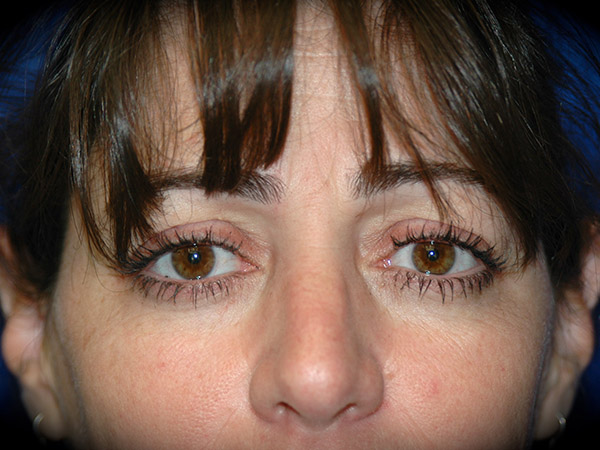 Brow Lift before and after - before