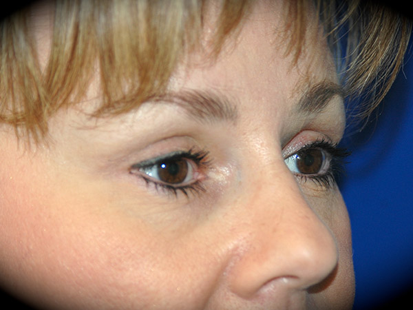 Brow Lift before and after - after