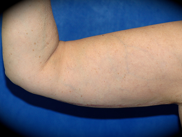Arm Lift before and after - after