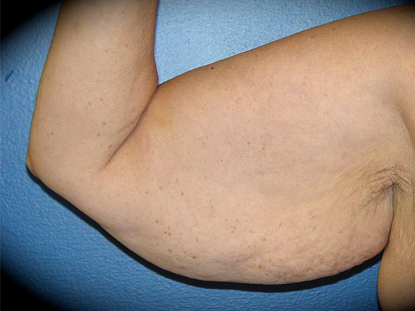 Arm Lift before and after - before