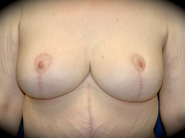 Breast Reduction before and after - after