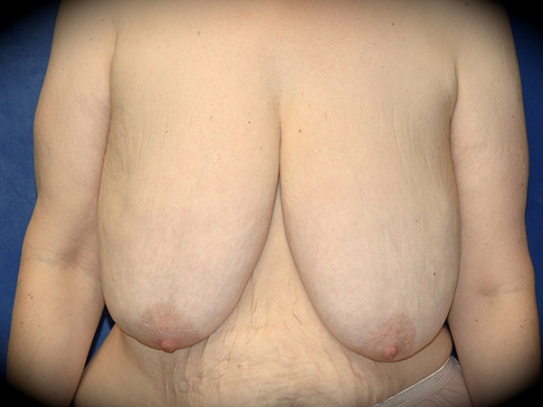 Breast Reduction before and after - before