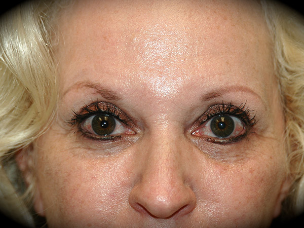 Brow Lift before and after - after