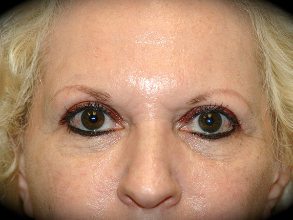 Brow Lift before and after - before