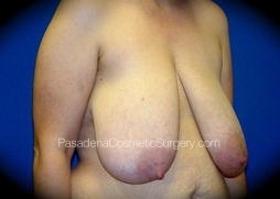 Breast Reduction before and after - before