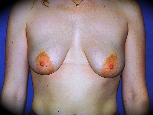 Breast Augmentation with Mastopexy before and after - before