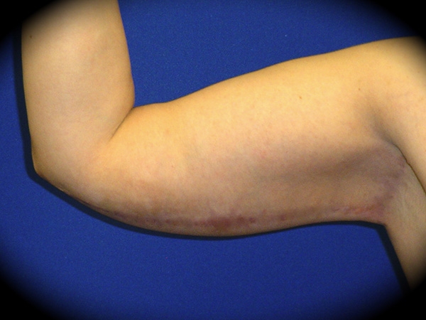 Arm Lift before and after - after