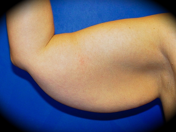 Arm Lift before and after - before