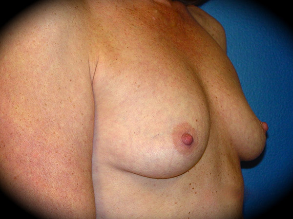 Breast Augmentation before and after - before