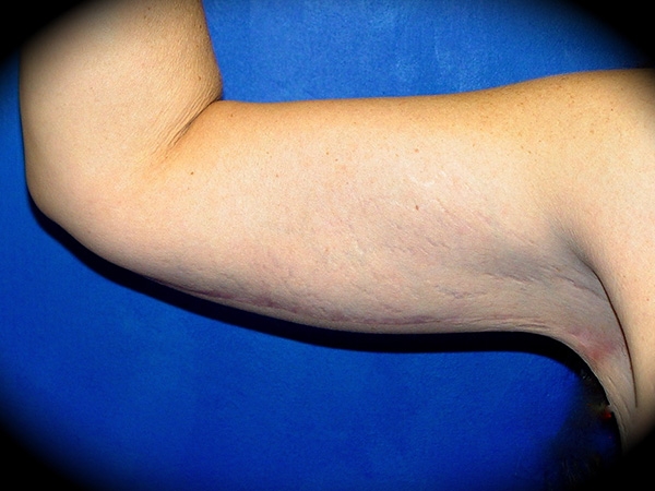 Arm Lift before and after - after