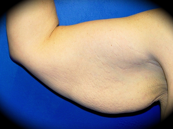 Arm Lift before and after - before