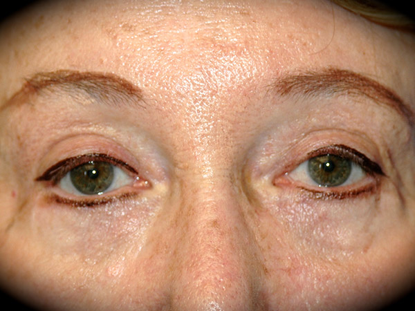 Brow Lift before and after - after