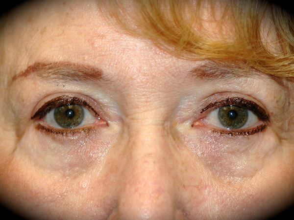 Brow Lift before and after - before