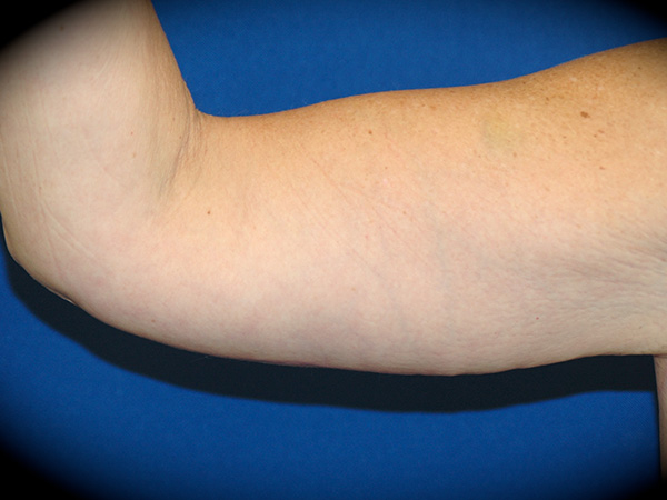 Arm Lift before and after - after