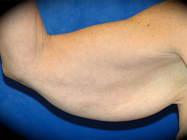 Arm Lift before and after - before