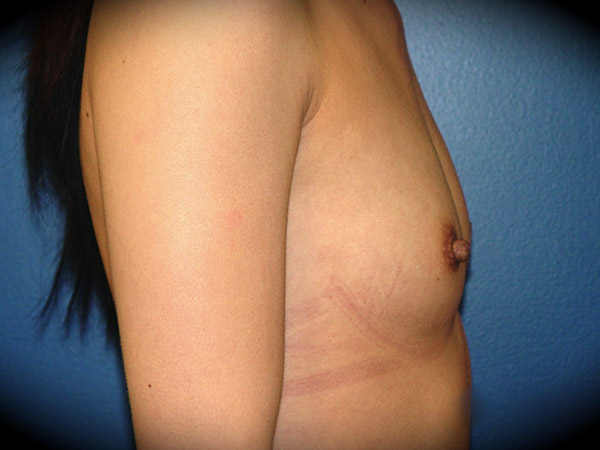 Breast Augmentation before and after - before
