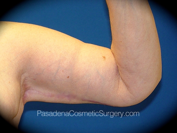 Arm Lift before and after - after