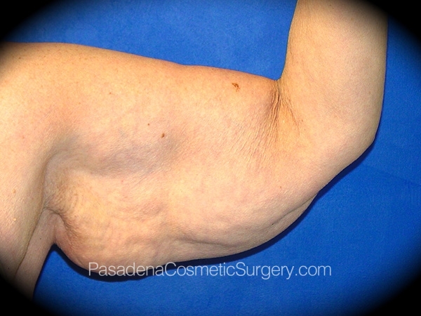 Arm Lift before and after - before