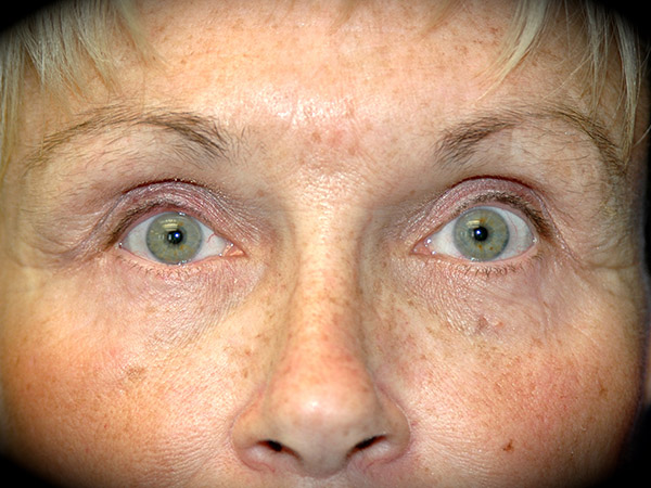 Brow Lift before and after - after