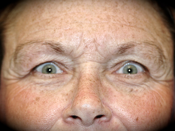 Brow Lift before and after - before