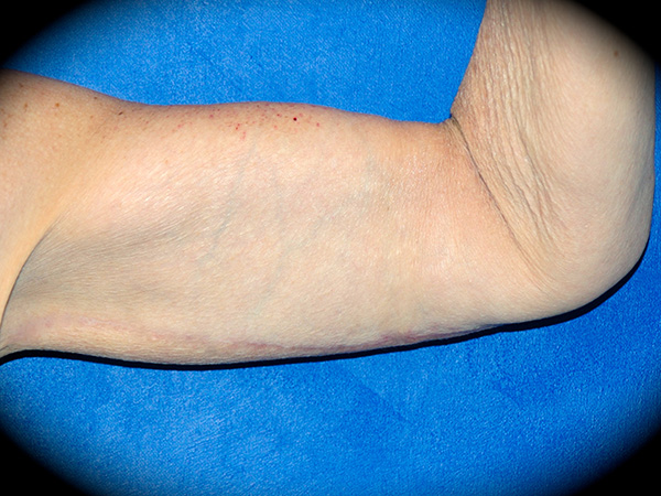 Arm Lift before and after - after