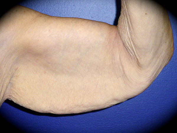 Arm Lift before and after - before