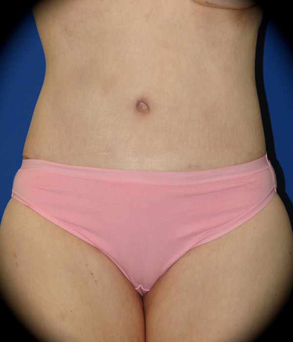 Body Lift before and after - after