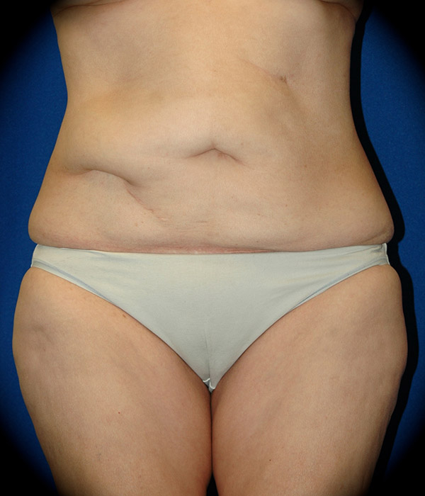 Body Lift before and after - before