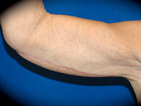 Arm Lift before and after - after
