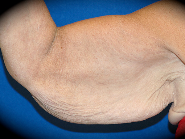 Arm Lift before and after - before