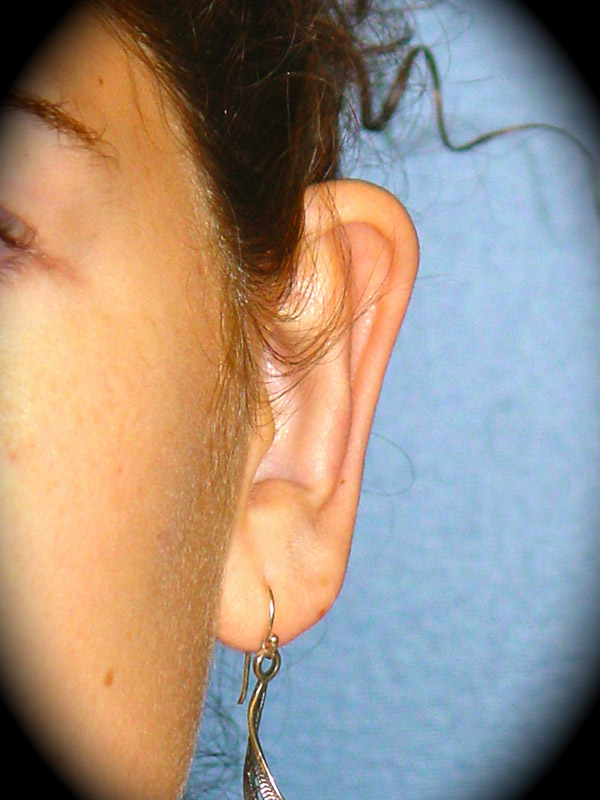 Ear Surgery before and after - after