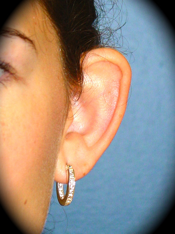 Ear Surgery before and after - before