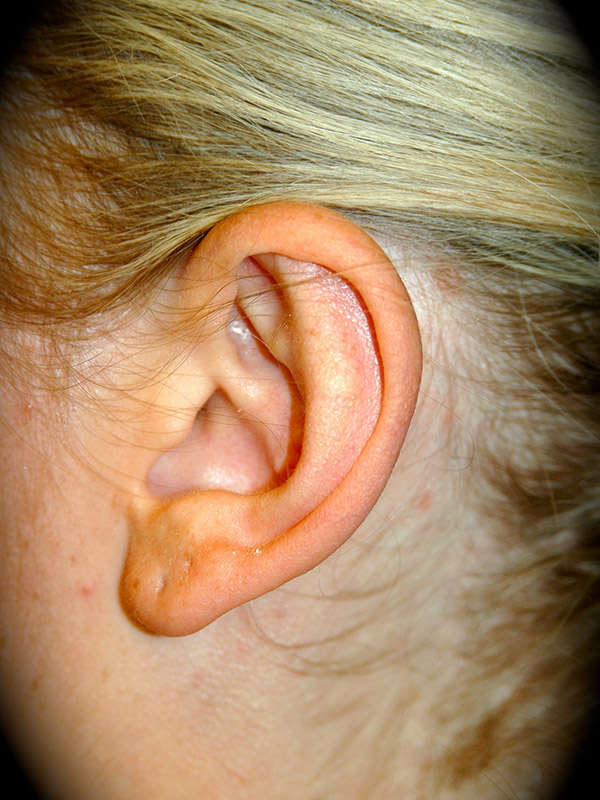 Ear Surgery before and after - after