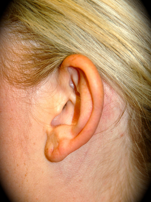 Ear Surgery before and after - before