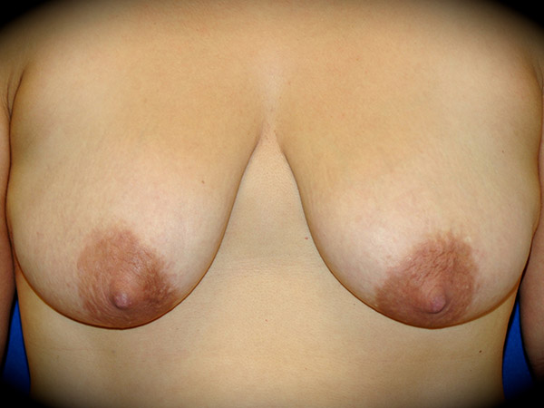 Breast Augmentation with Mastopexy before and after - before