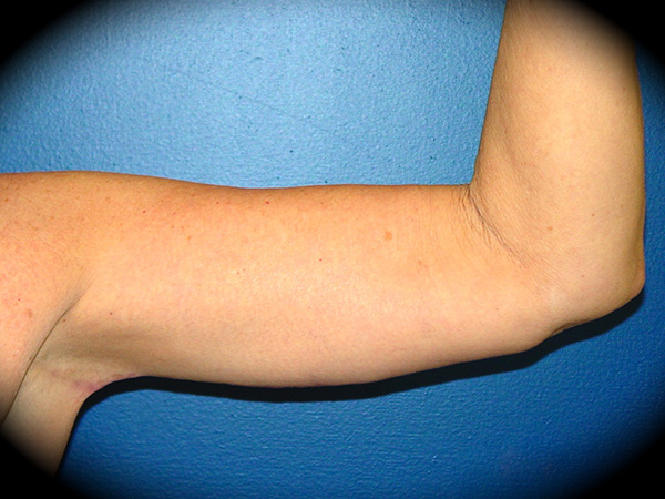 Arm Lift before and after - after