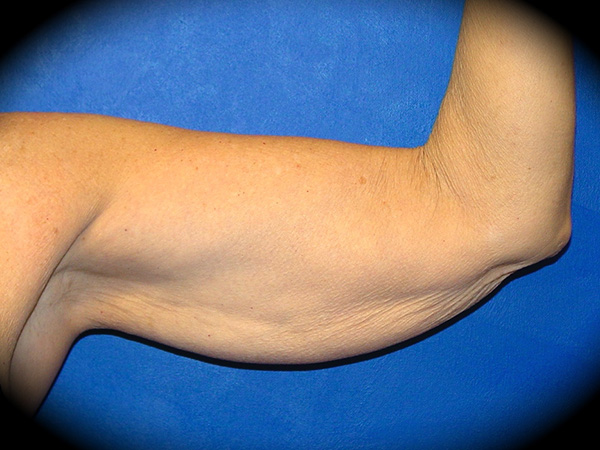 Arm Lift before and after - before
