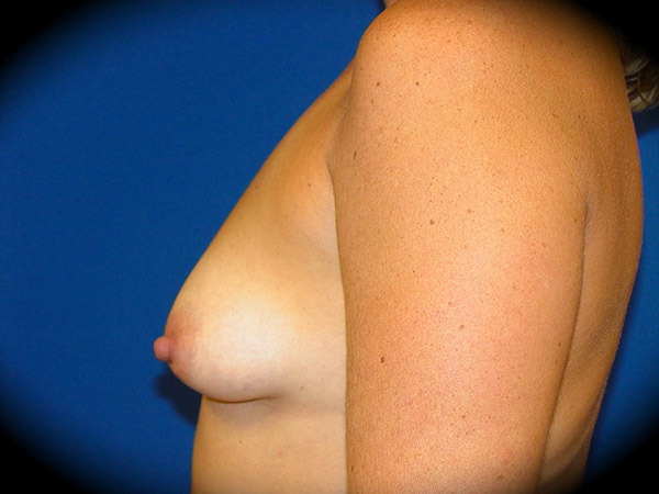 Breast Augmentation before and after - before