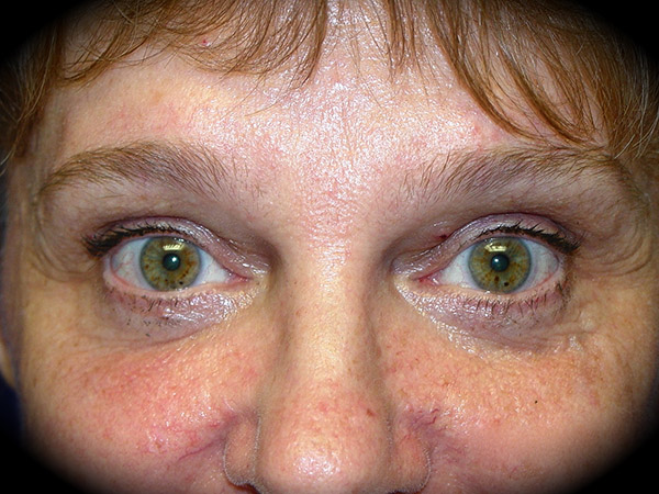Brow Lift before and after - after