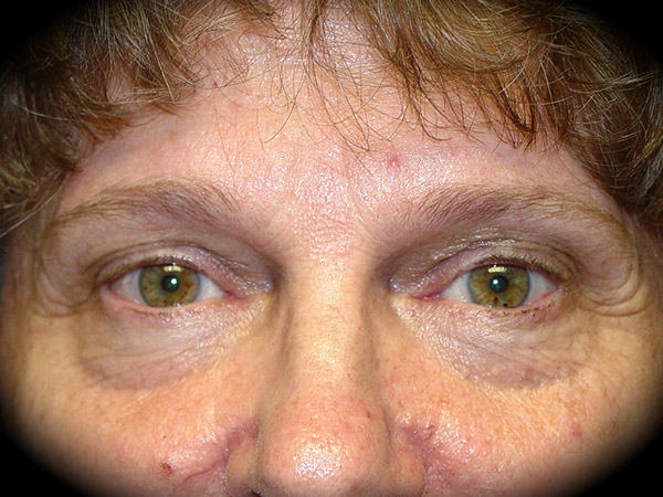 Brow Lift before and after - before