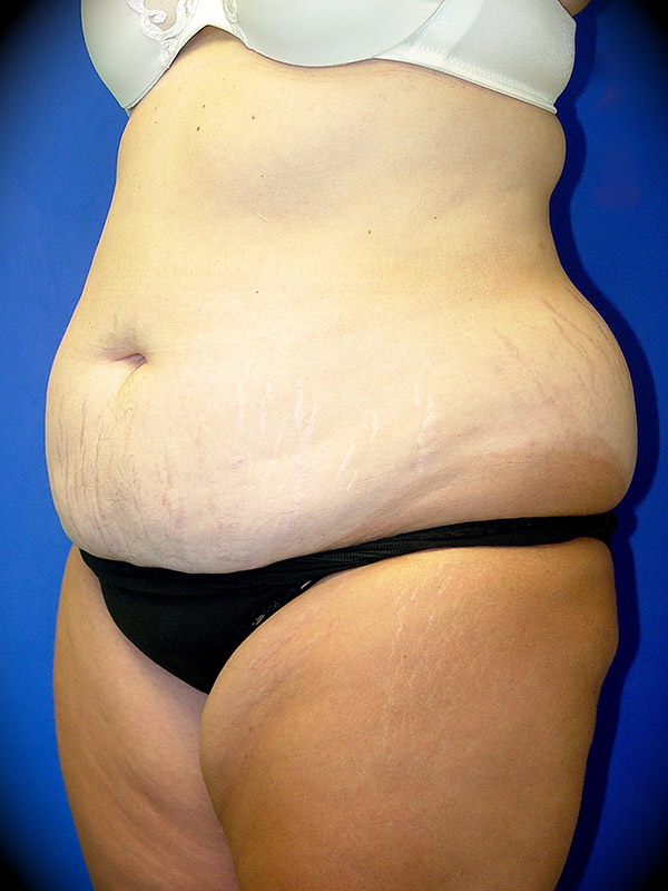 Body Lift before and after - before