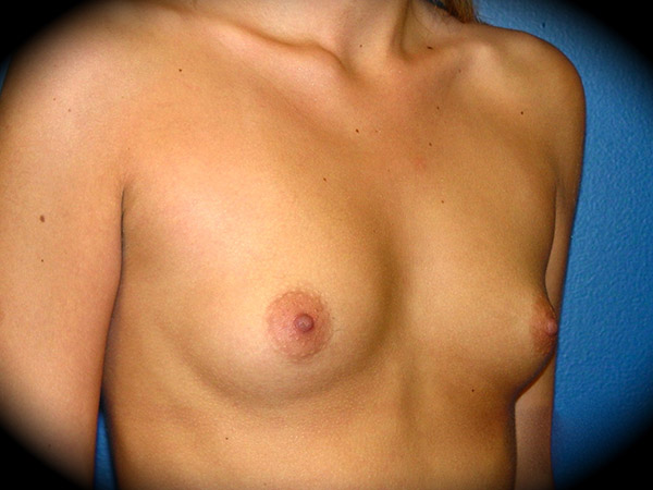 Breast Augmentation before and after - before