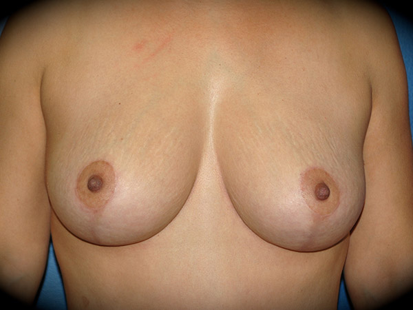 Breast Lift before and after - after